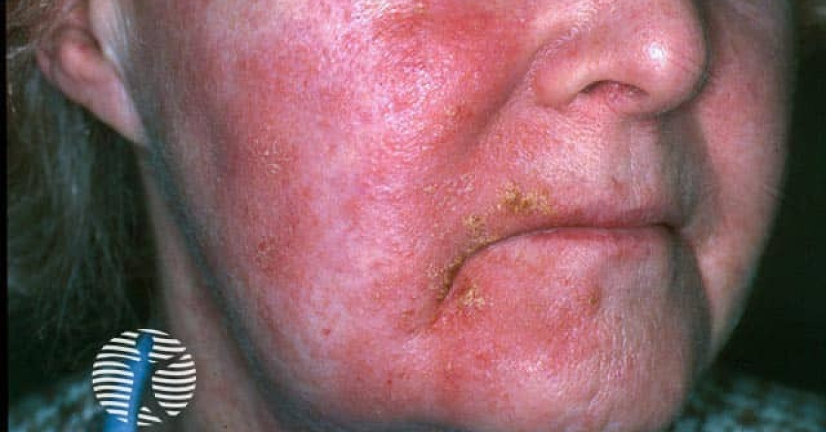 Allergic contact dermatitis image