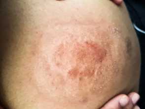 Allergic contact dermatitis