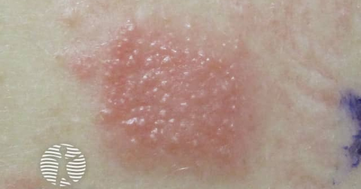 patch test paraben mix 022 image