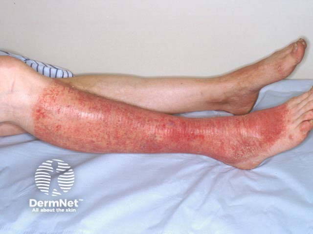 Well-demarcated eczema on the lower leg due to allergy to a Viscopaste bandage; parabens were the culprit allergen