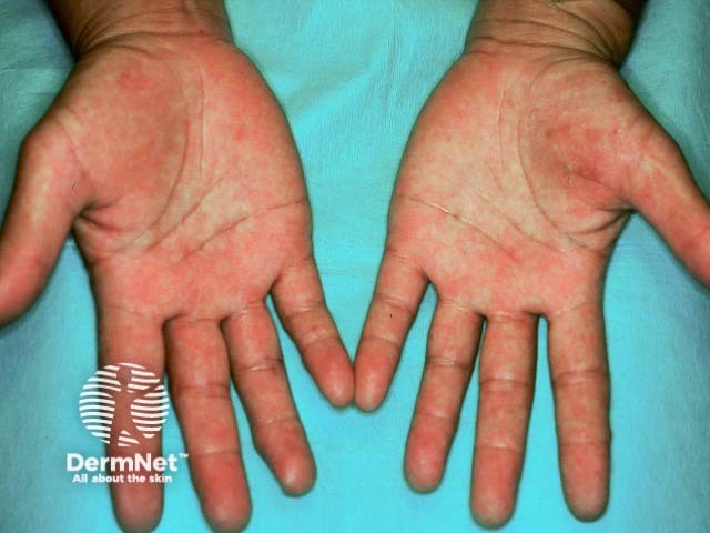 Type 4 latex allergy producing palmar eczema