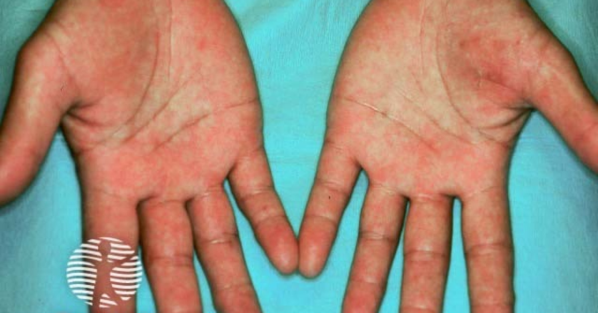 Allergic contact dermatitis image