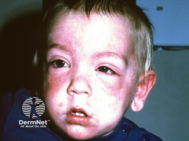 An acute urticarial reaction in an atopic boy who was latex sensitive and played with a balloon