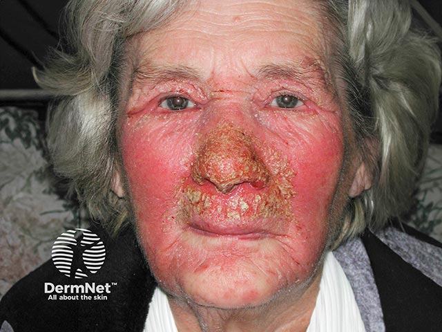 Allergic contact dermatitis due to a nasal ointment containing chlorhexidine and neomycin