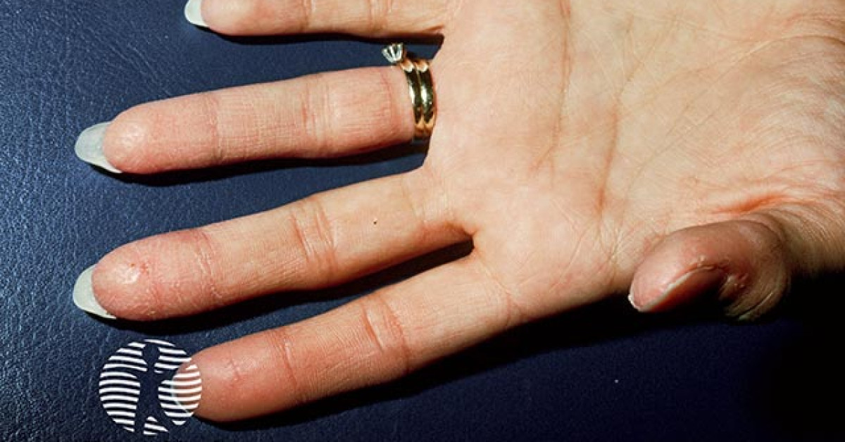 Allergic contact dermatitis image