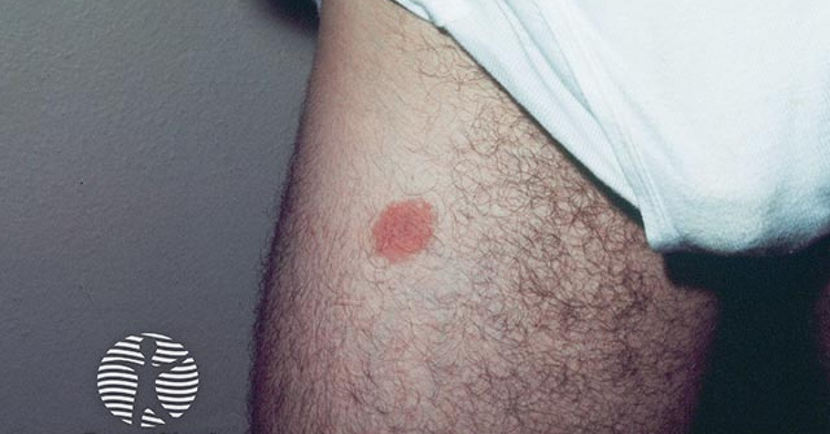 Termite Rash Allergic contact dermatitis image