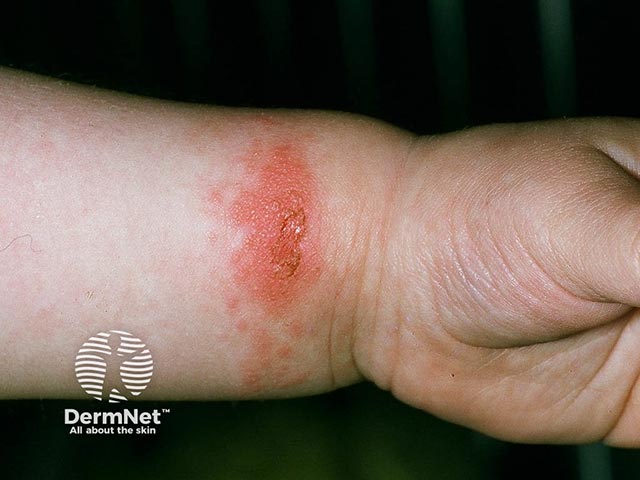 Nickel allergy on the wrist from a bangle
