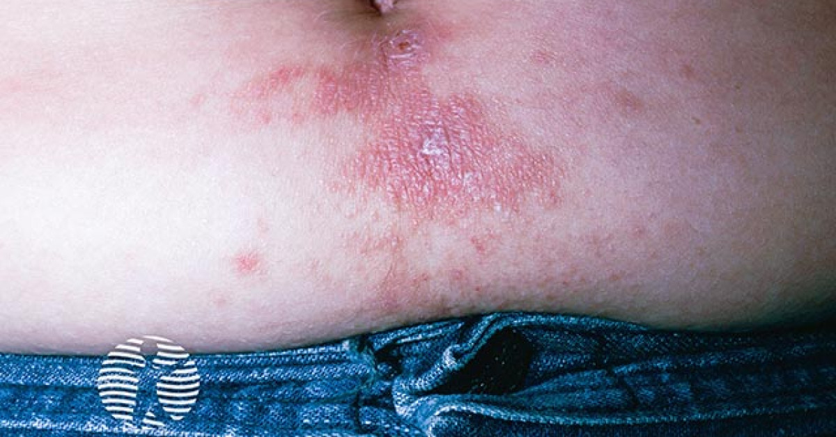 Cauliflower Rash Allergic contact dermatitis image