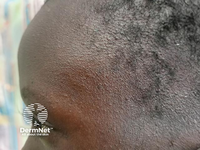 Contact allergy on the face due to a herbal soap constituent