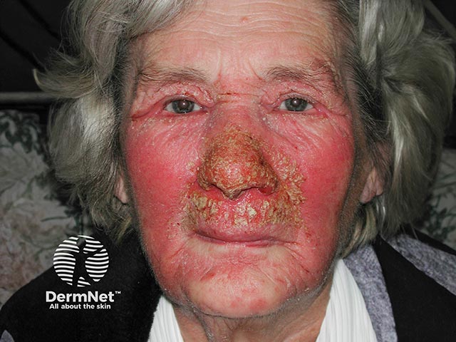 Allergic contact dermatitis due to a nasal ointment containing chlorhexidine and neomycin