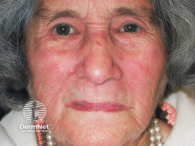 Resolved contact dermatitis after using a moderate potency topical steroid for 5 days