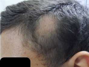 Alopecia Areata: Causes, Diagnosis, and Treatment — DermNet