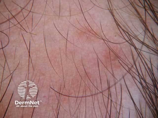 Dermoscopic image showing normal follicular openings with vellus hairs