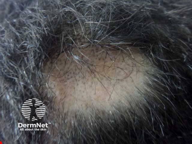 A single patch of alopecia areata on the vertex