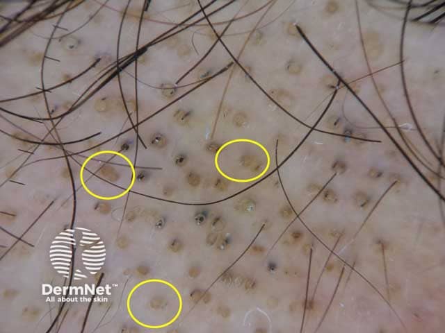 Dermoscopic image of alopecia areata showing yellow dots; follicular infundibulae are filled with keratinous material with no hair shafts. Black dots are also presented.