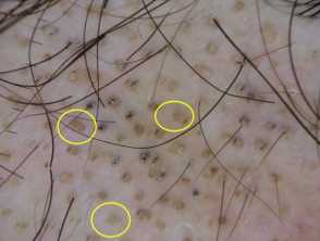 Alopecia Areata Images — DermNet
