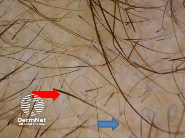 Thinning of the hair shaft at the proximal end (blue arrow) with normal thickness at the distal end (red arrow)