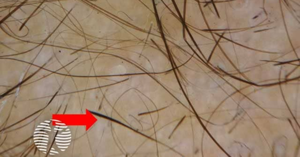 Alopecia areata image