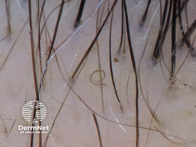 Dermoscopic image of alopecia areata showing a pigtail hair: short twisted hair representing a regrowing hair