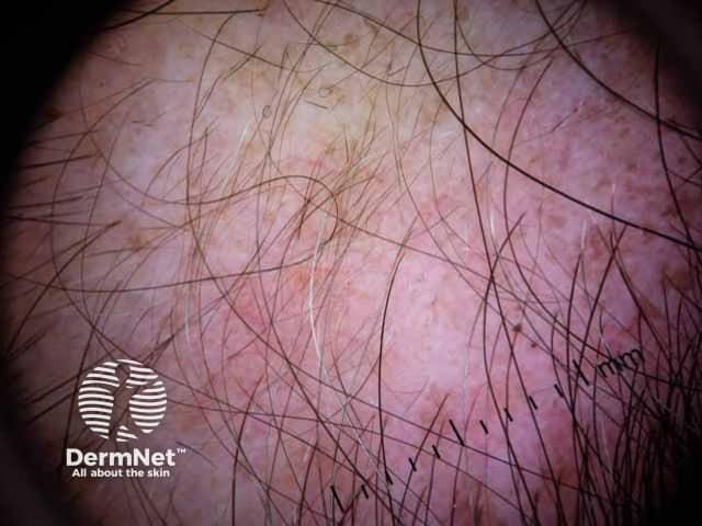 Dermoscopic image of alopecia areata showing pigment from hair dye