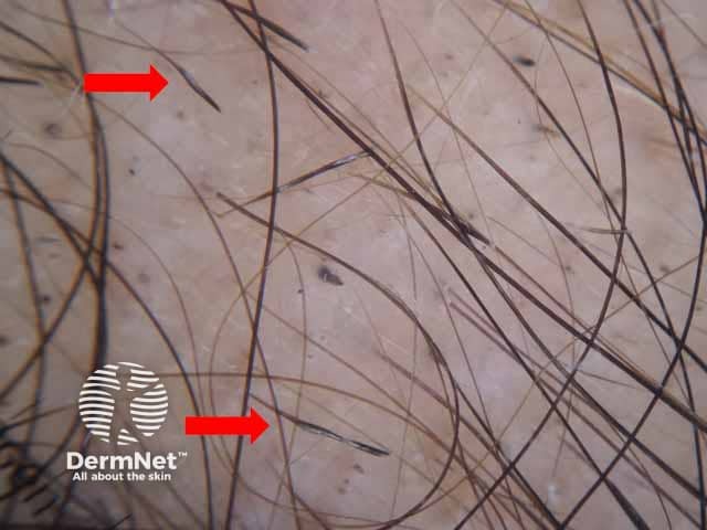Dermoscopic image of long standing alopecia areata showing Pohl-Pinkus constriction; irregular fusiform narrowings of the hair shaft