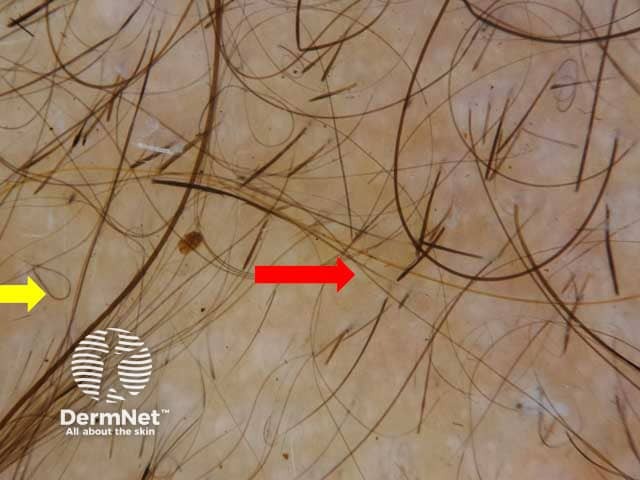 Dermoscopic image of a male patient with alopecia areata showing tapered hair (Red arrow) and regrowing hair (Yellow arrow)