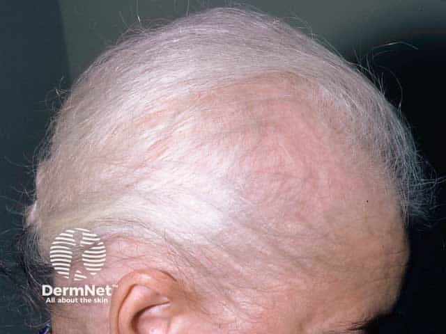Extensive alopecia areata with retention of grey hairs