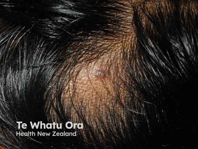 Alopecia areata on the lateral scalp