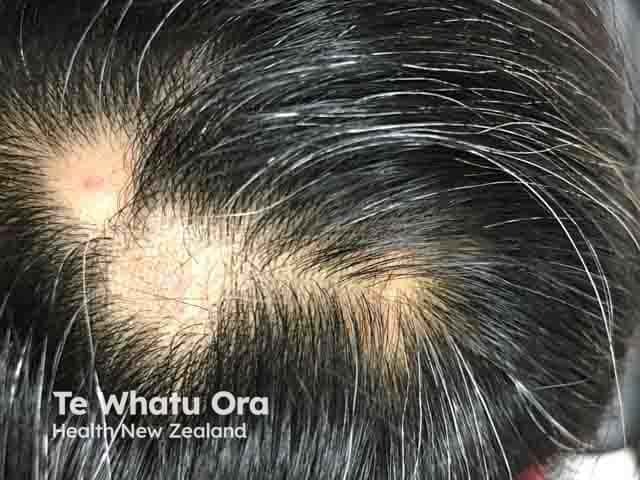 Patch alopecia areata with poliosis in a 14 year old
