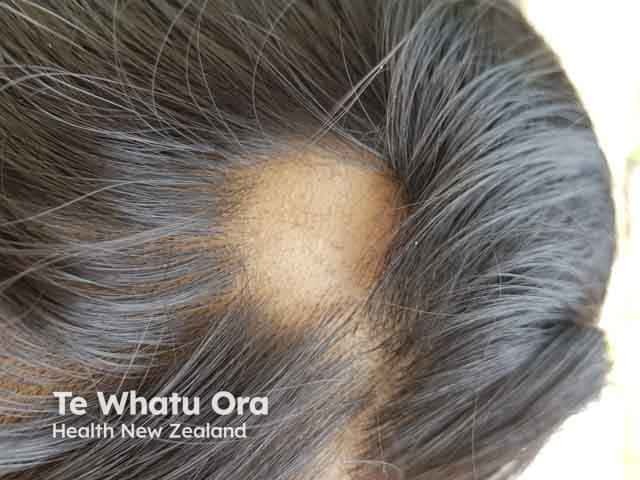Alopecia areata of the top of the scalp