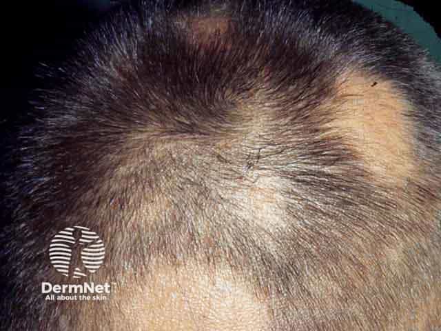 Several patches of alopecia areata on the scalp
