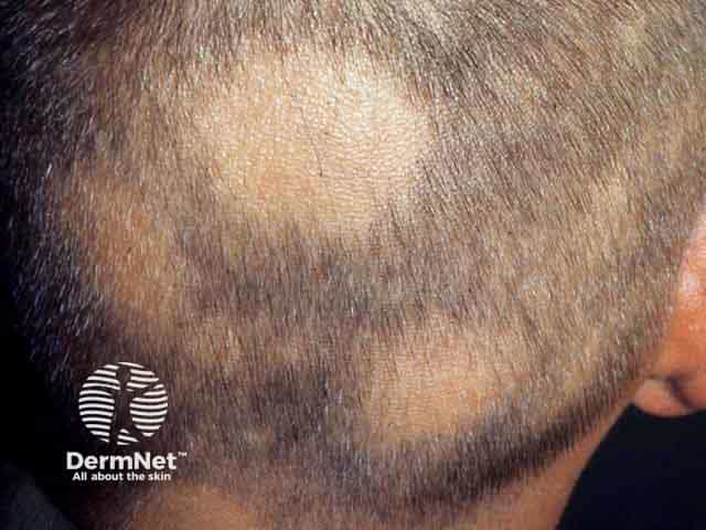 Extensive patchy alopecia areata