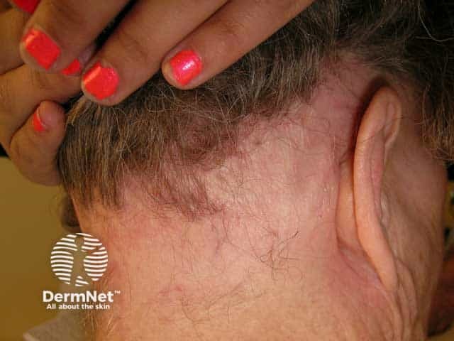 Ophiasic pattern alopecia areata