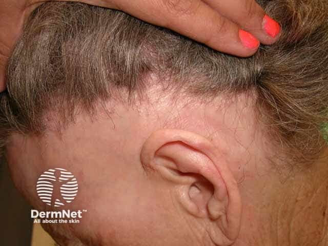 Ophiasic pattern alopecia areata
