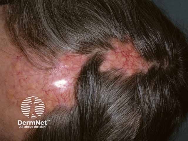 Alopecia neoplastica image