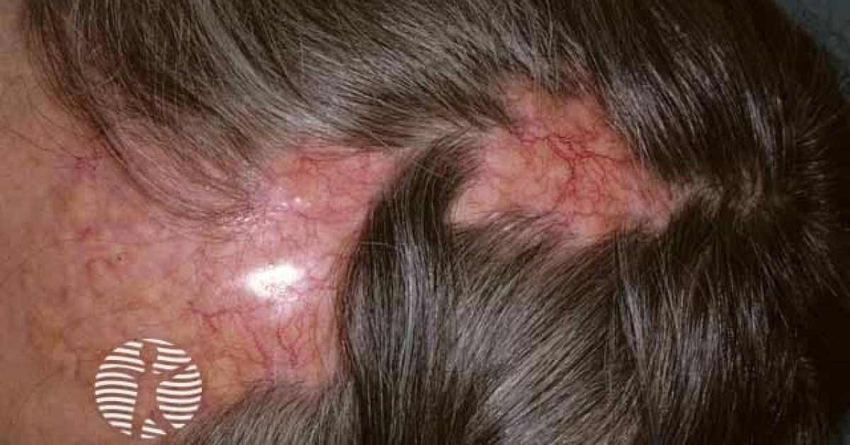 Alopecia Neoplastica Image