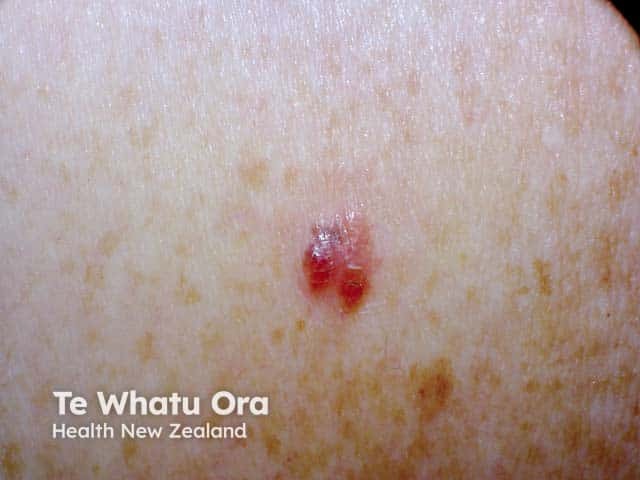 An irregularly marginated red lesion on the arm - an amelanotic melanoma