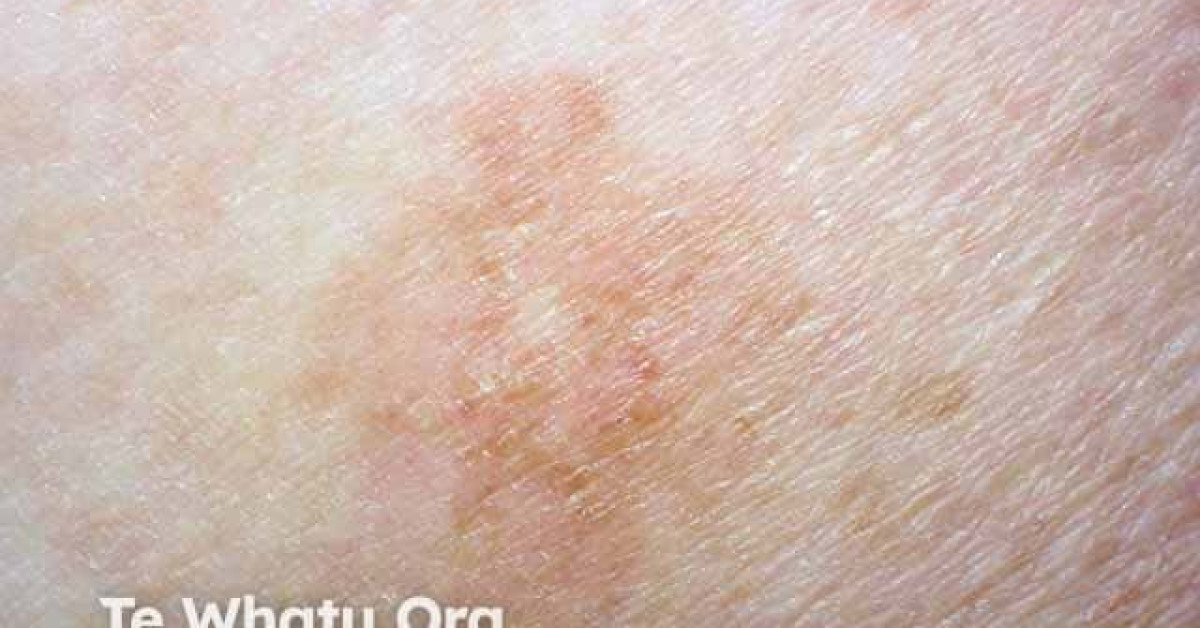 Amelanotic melanoma image