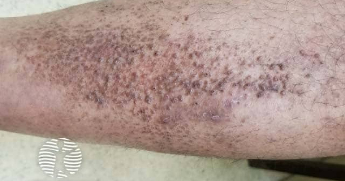 Amyloidosis image