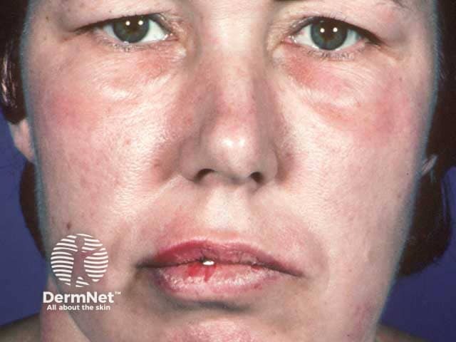 Lip and lid angioedema, no cause was elucidated