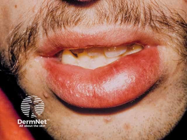 Resolving lip angioedema
