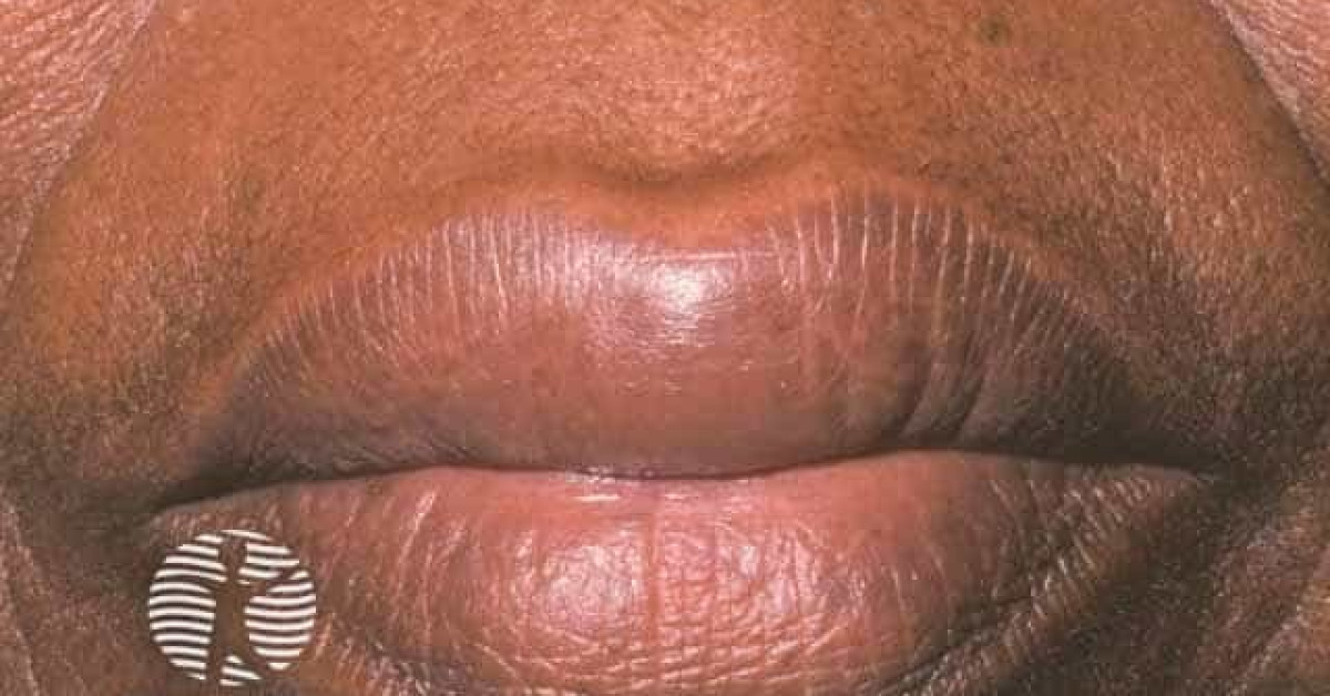 Angioedema image