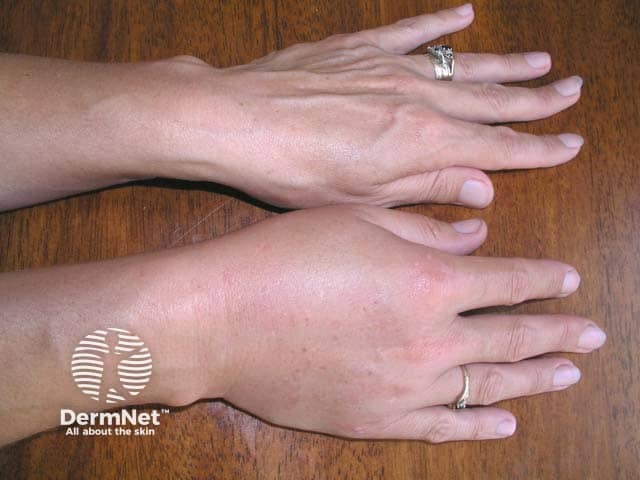 Angioedema of the right hand