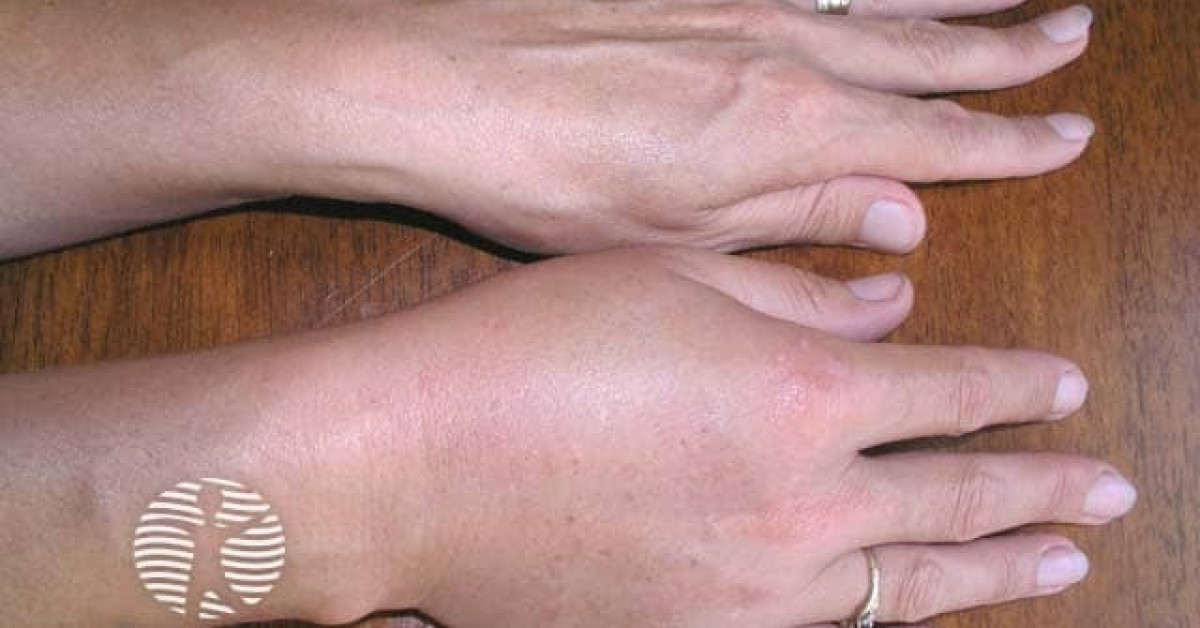 Angioedema image