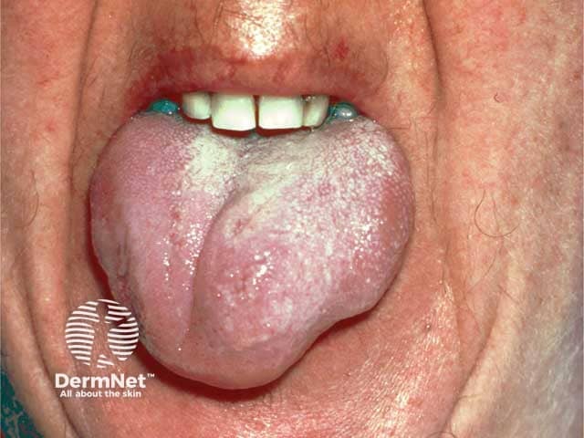 Angioedema due to acquired C1esterase deficiency and an underlying lymphoma; it responded to rituximab