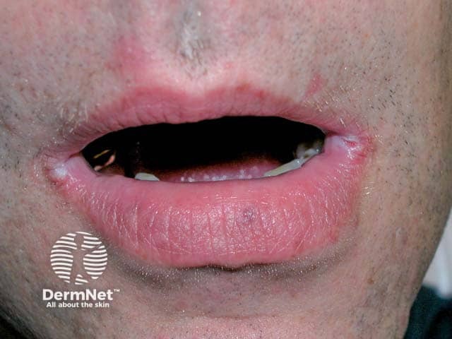 Bilateral angular cheilitis with grey macceration at the angles of the mouth