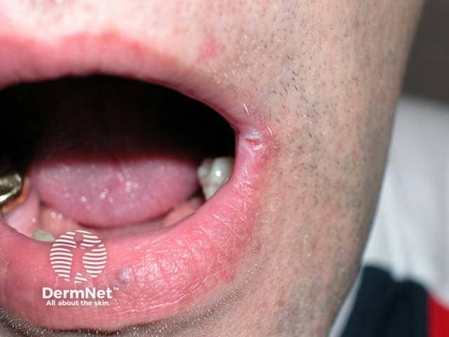 Angular cheilitis with grey macceration at the angle of the mouth