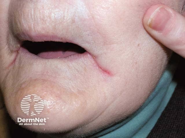 An edentulous woman with redness and oozing in the lateral oral crease