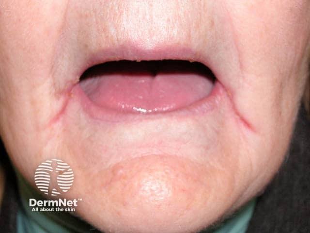 An edentulous woman with redness and oozing in the lateral oral creases due to angular cheilitis