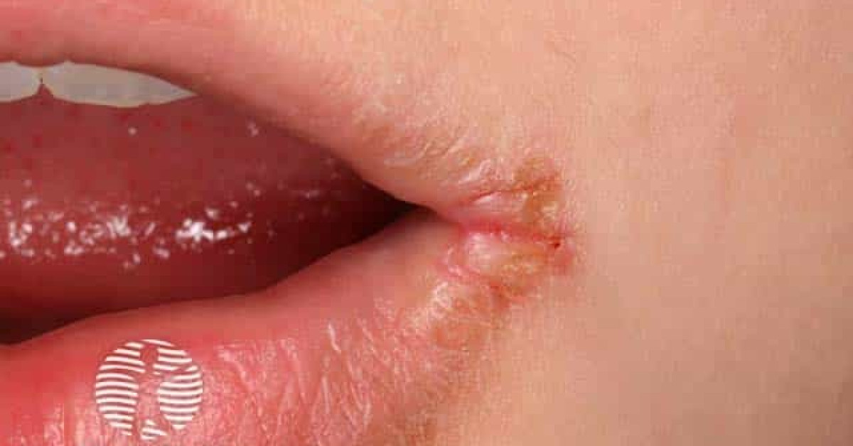 Angular cheilitis image